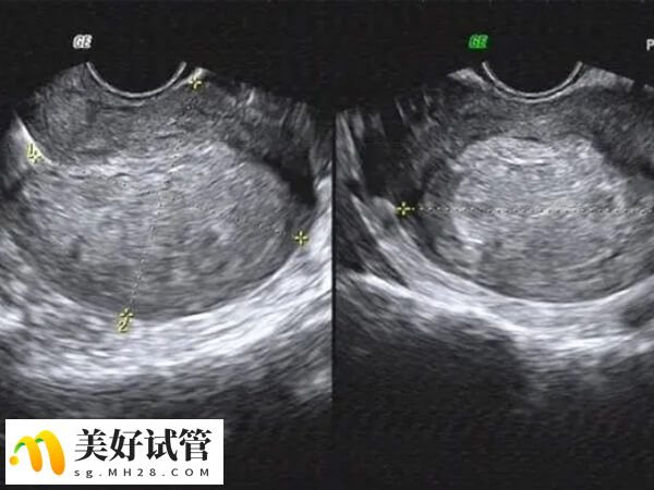 移植前查内膜可确定移植窗口期