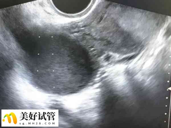 子宫腺肌症是一种特殊的子宫内膜异位症