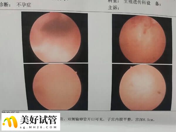 宫腔粘连需要手术治疗